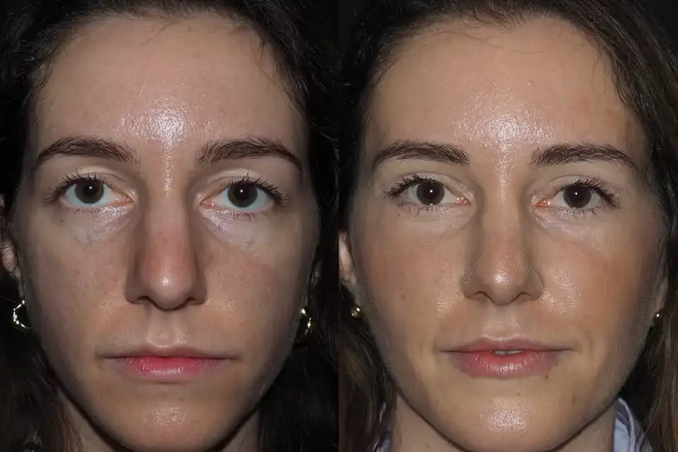 Before-After-best-brow-lift-clinic-dubai-Abu-dhabi-al-ain-sharjah-uae-near-me-1