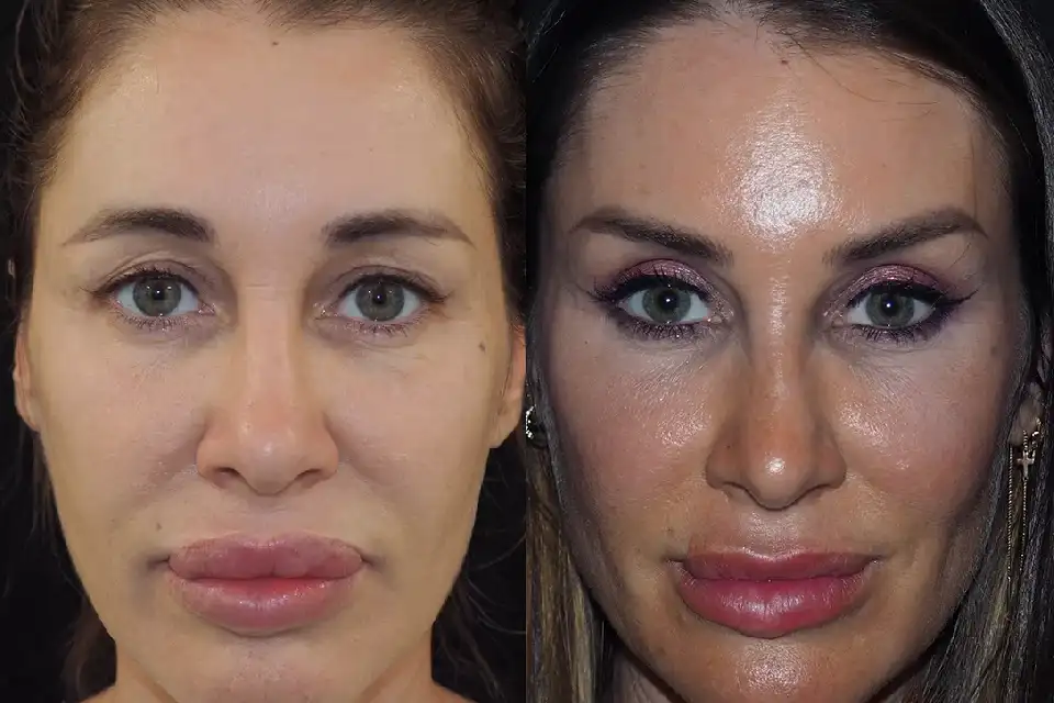 Before-After-best-brow-lift-nose-surgeon-near-me-jumeirah-uae-1