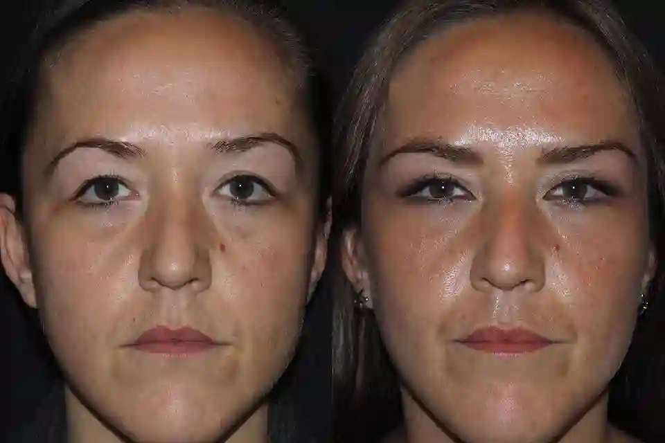 Before-After-best-brow-lift-nose-surgery-clinic-sharjah-al-ain-uae-united-arab-emirates-near-me-1