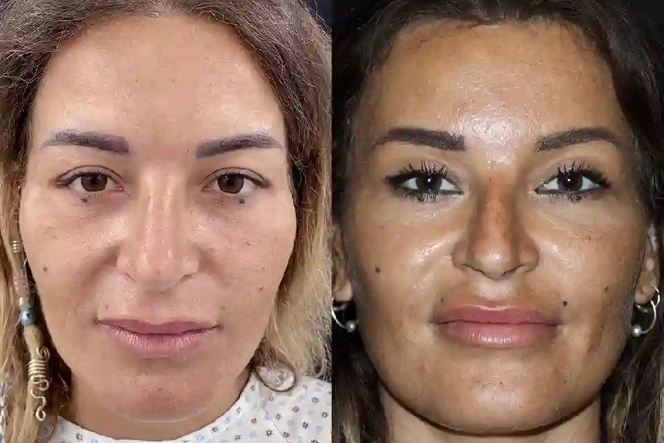 Before-After-best-forehead-lift-clinic-dubai-abu-dhabi-al-ain-sharjah-uae-near-me-1