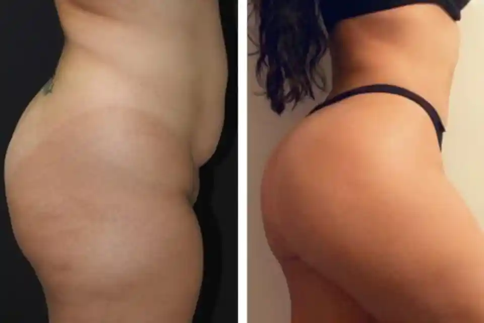 Before-After-best-liposuction-surgery-lipo-fat-removal-clinic-dubai-Abu-dhabi-al-ain-sharjah-uae-near-me