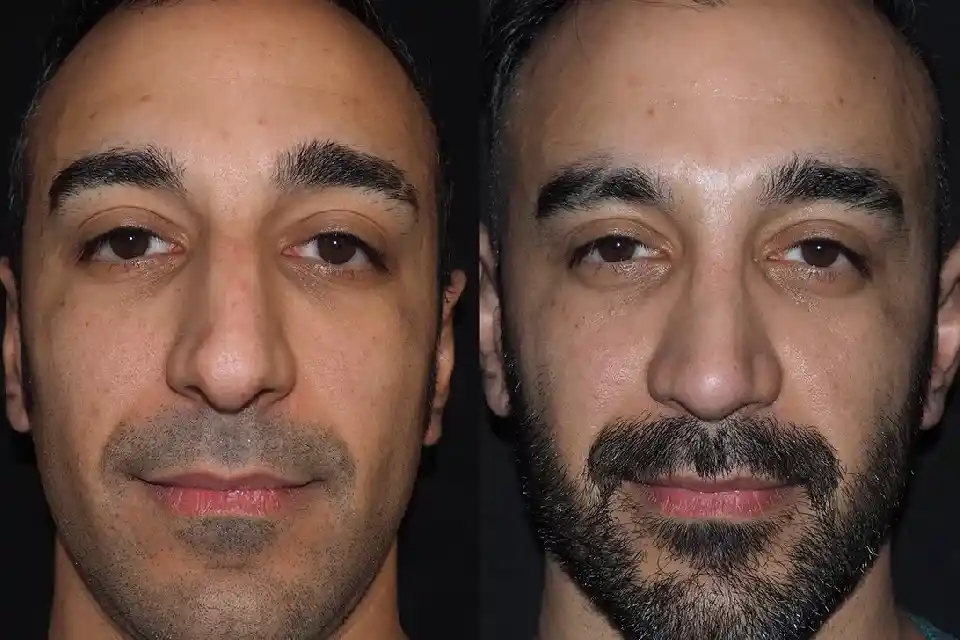 Before-After-best-male-nose-job-clinic-dubai-Abu-dhabi-al-ain-sharjah-uae-near-me-1-1.webp