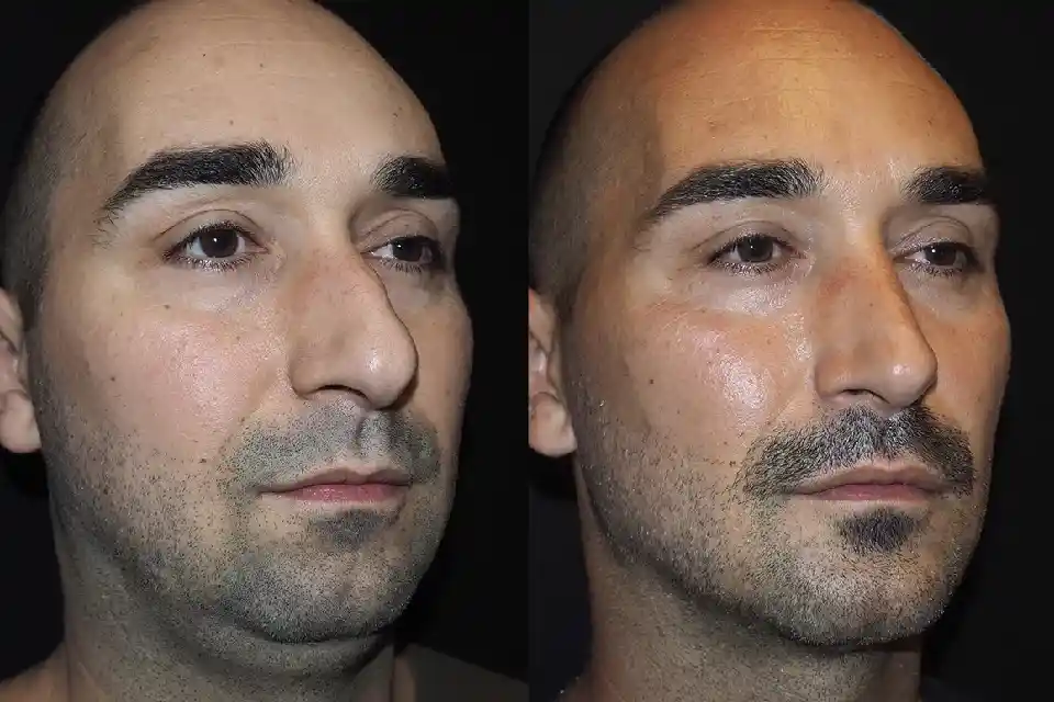 Before-After-best-male-nose-job-clinic-dubai-Abu-dhabi-al-ain-sharjah-uae-near-me-1.webp