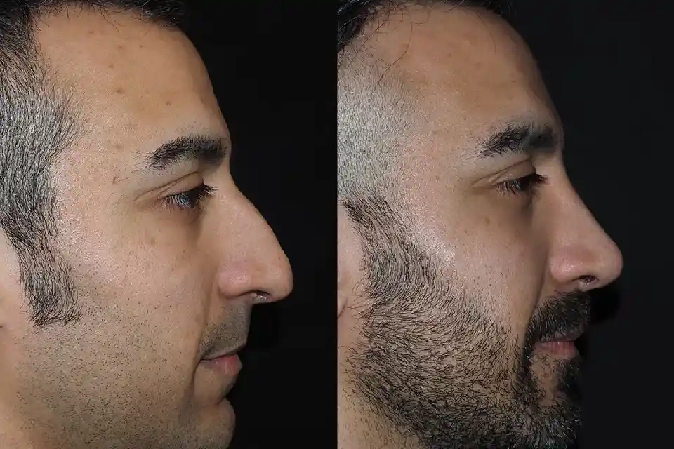 Before-After-best-male-nose-job-clinic-dubai-Abu-dhabi-al-ain-sharjah-uae-near-me-2.webp