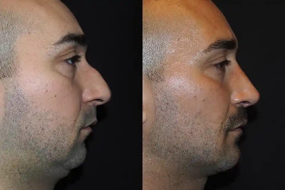 Before-After-best-male-rhinoplasty-nose-surgeon-near-me-jumeirah-uae-1.webp