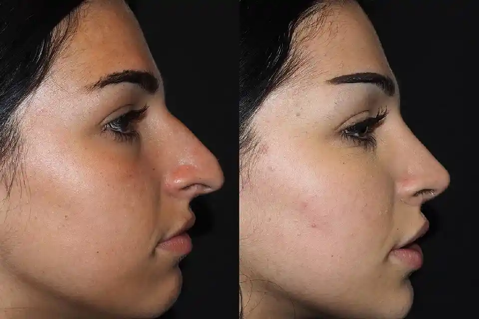 Before-After-best-nose-job-clinic-dubai-Abu-dhabi-al-ain-sharjah-uae-near-me-2.webp