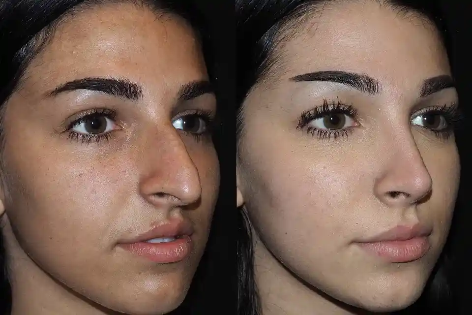 Before-After-best-rhinoplasty-clinic-dubai-abu-dhabi-al-ain-sharjah-uae-near-me-2.webp