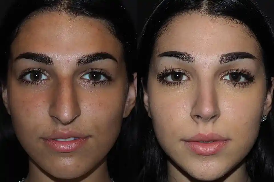 Before-After-best-rhinoplasty-nose-surgeon-near-me-jumeirah-uae-2.webp