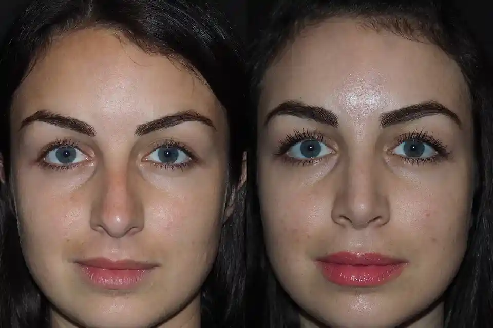 Before-After-best-rhinoplasty-nose-surgery-clinic-sharjah-al-ain-uae-united-arab-emirates-near-me-2.webp