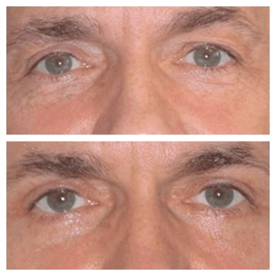 Before-after-eyelids-surgery