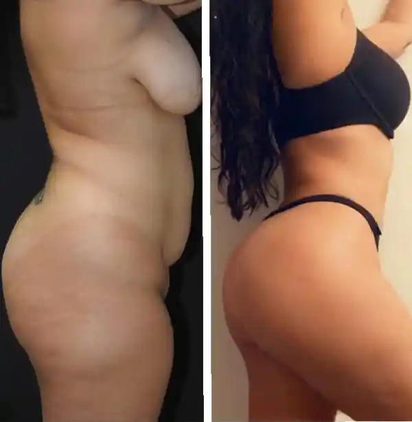 Before-and-after-body-contouring-sculpting-Jumeirah