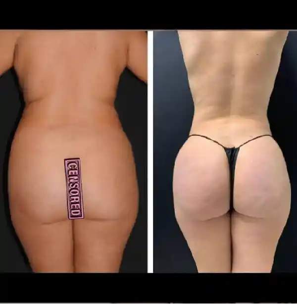 Before-and-after-body-contouring-sculpting-in-dubai-abu-dhabi