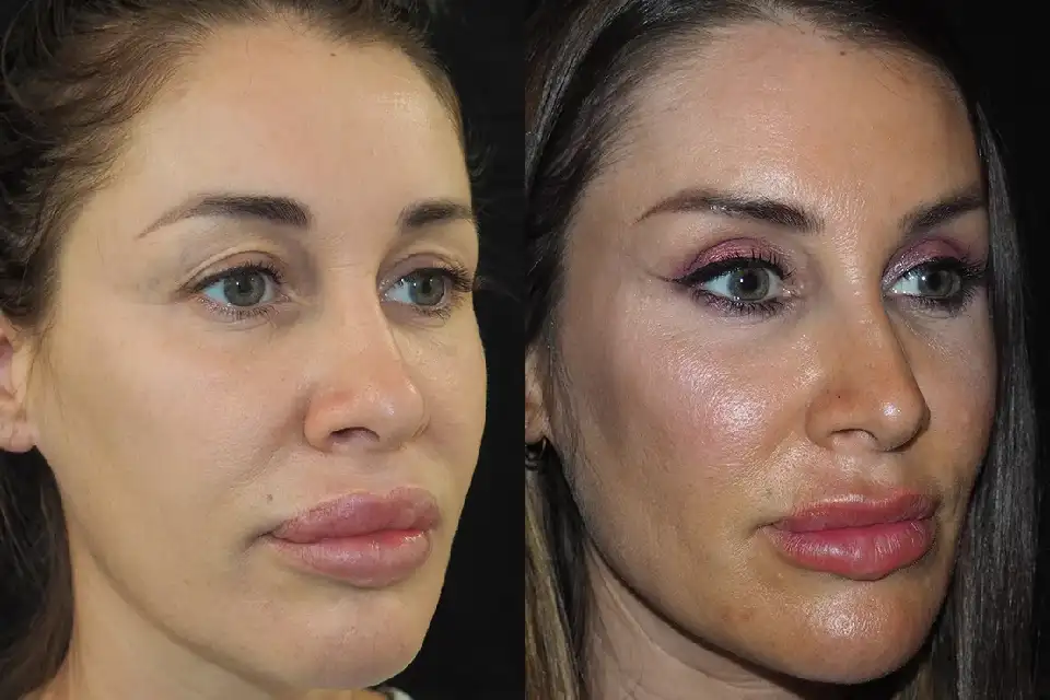 Before-and-after-brow-lift-surgery-Jumeirah-1