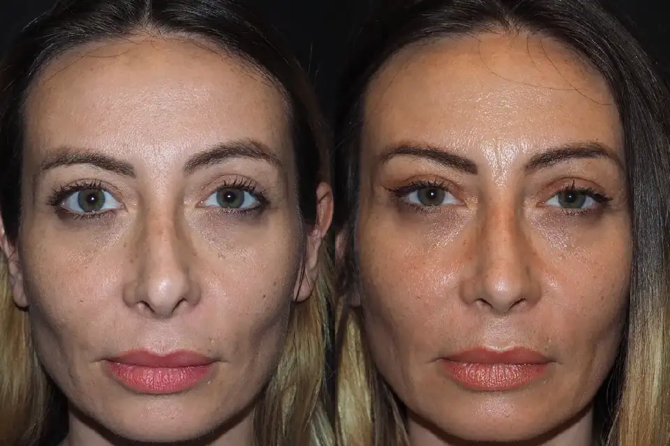 Before-and-after-forhead-lift-surgery-1