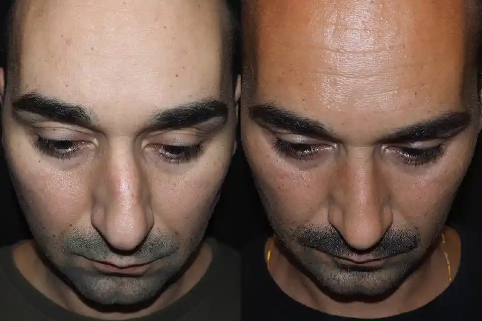 Before-and-after-male-rhinoplasty-nose-surgery-2.webp