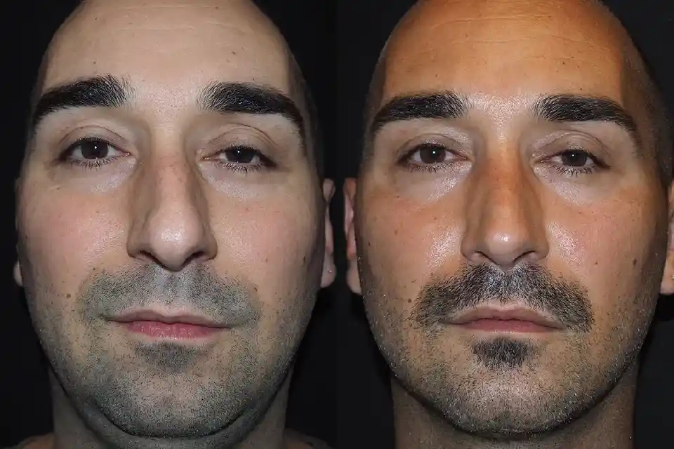 Before-and-after-male-rhinoplasty-nose-surgery-Jumeirah-1.webp