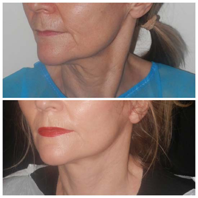 Before-and-after-neck-lift-at-perfect-doctors-clinic