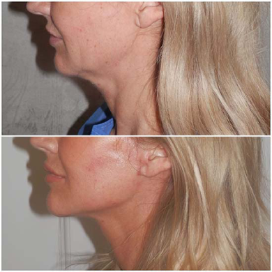 Before-and-after-neck-lift-dubai