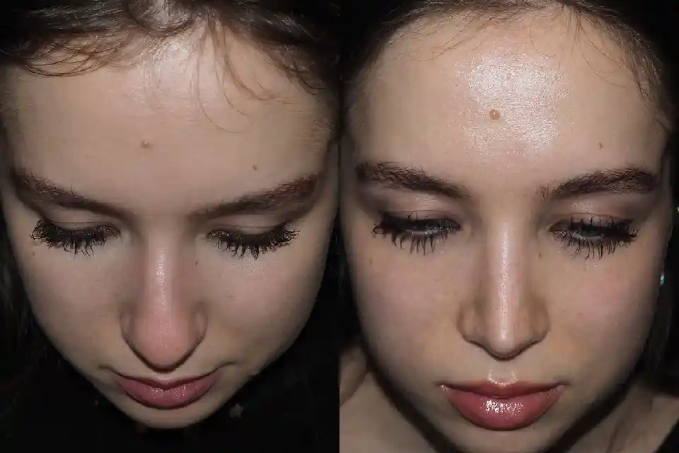 Before-and-after-rhinoplasty-nose-surgery-2.webp