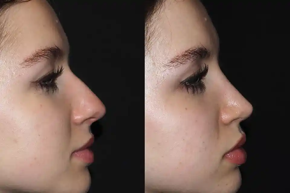 Before-and-after-rhinoplasty-nose-surgery-Jumeirah-2.webp