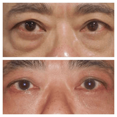 Best-Eyelids-surgery-at-perfect-doctors-clinic