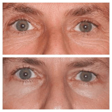 Blepharoplasty-Dubai