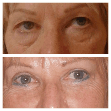 Blepharoplasty-results-at-perfect-doctors-clinic