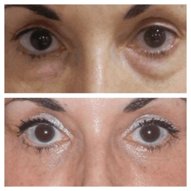 Eyelids-Dubai