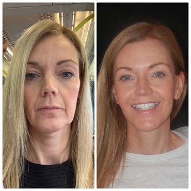 Facelift-surgery-dubai-abu-dhabi-uae