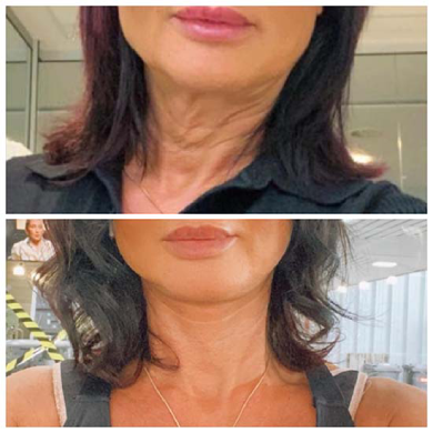 Neck-lift-dubai-abu-dhabi