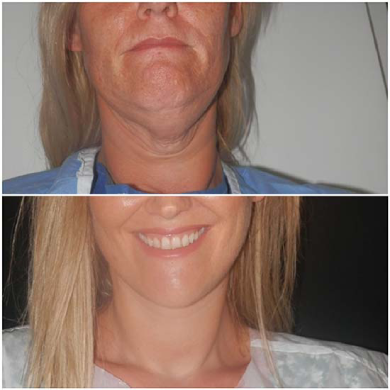 Neck-lift-perfect-doctors-clinic
