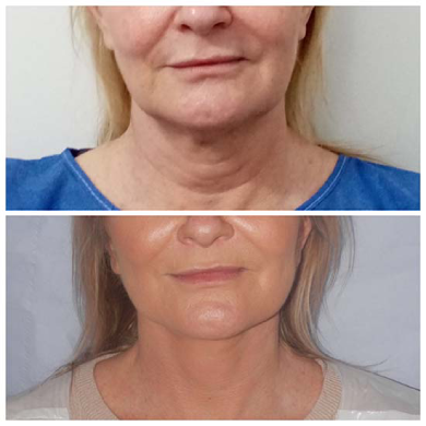 Neck-lift-results-perfect-doctors-clinic