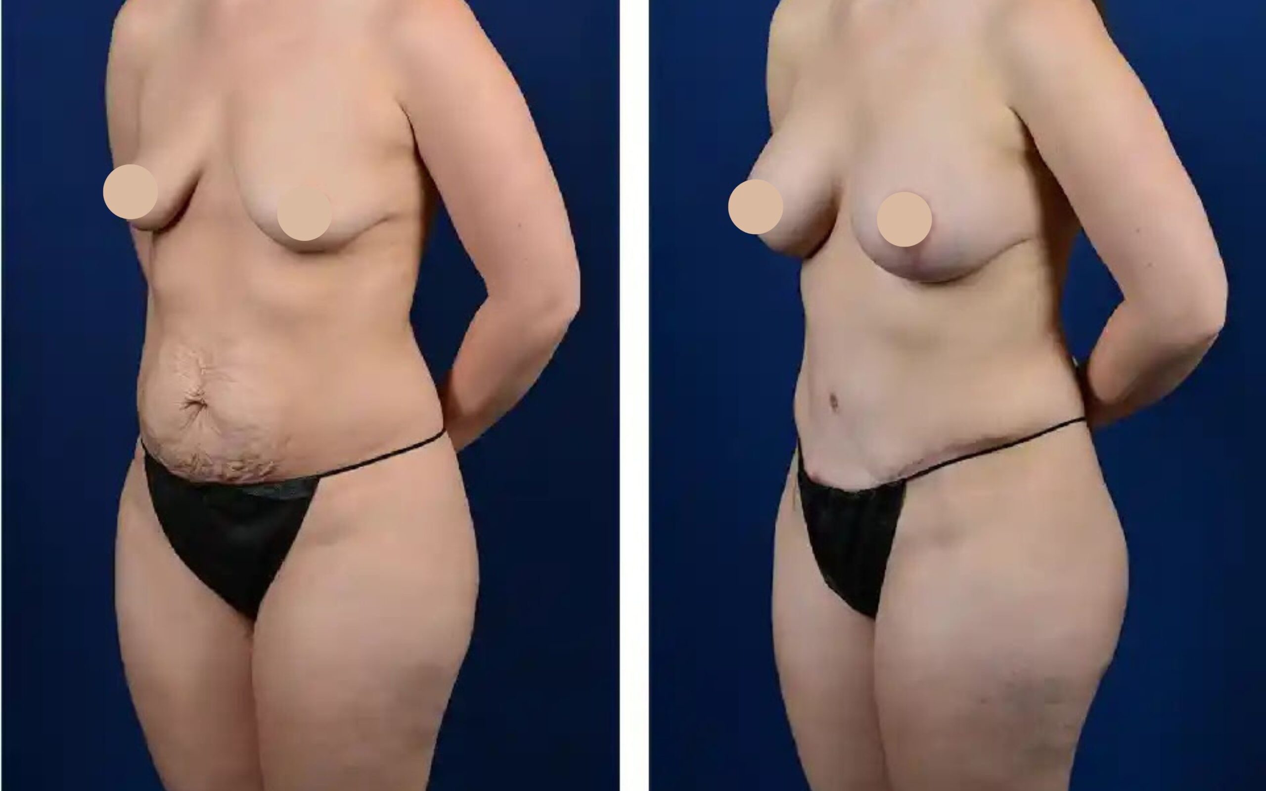 Patient-01-mommy-make-over-scaled