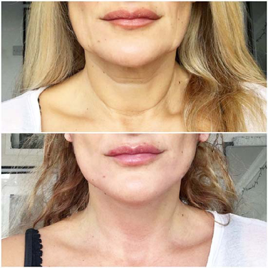 before-and-after-neck-lift